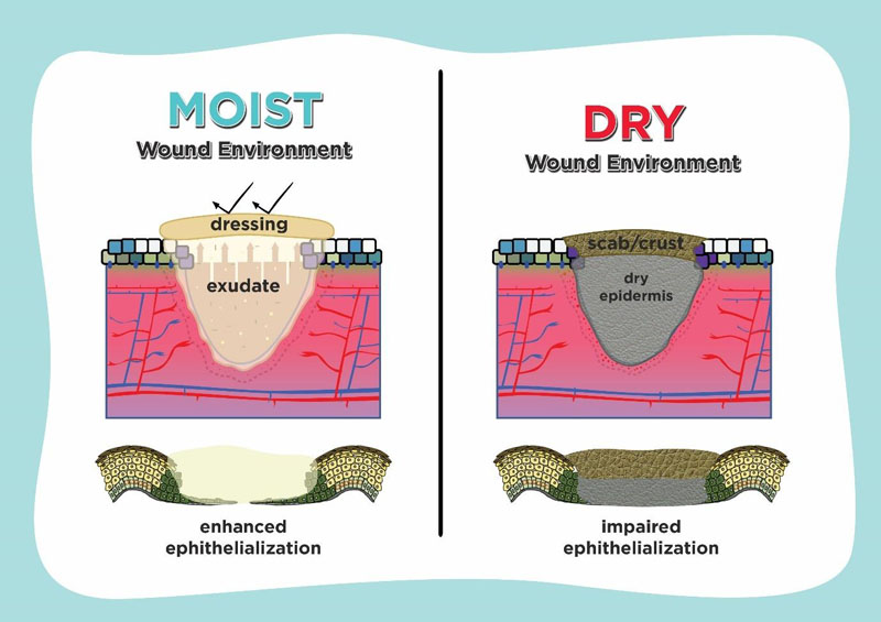 Lessons From Epithelialization The Reason Behind Moist Wound Environment